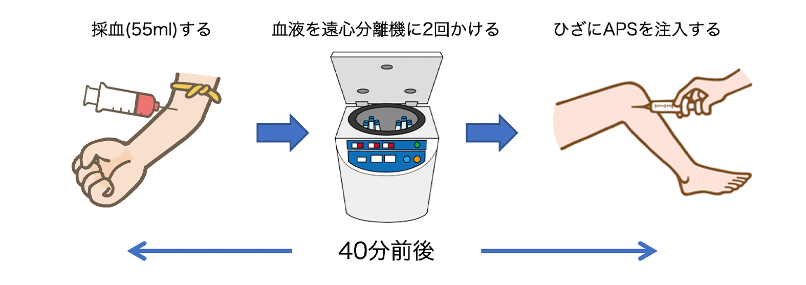 APS治療とは