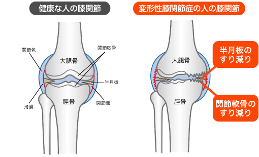 健康な人の股関節と変形性膝関節症の人の股関節