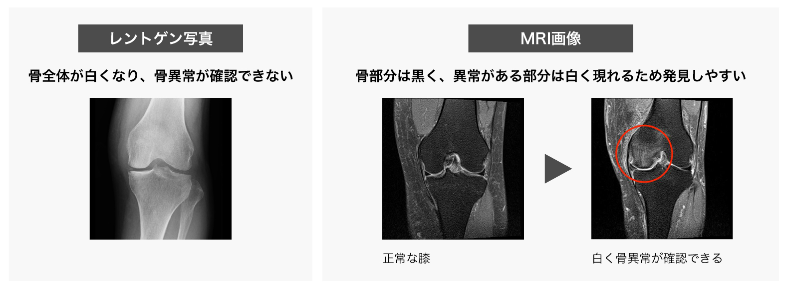 次のPDFにあるレントゲンとMRIの比較図