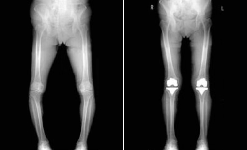 人工関節置換手術前後のレントゲン写真