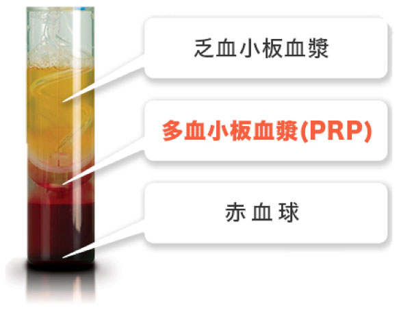 写真：PRP（多血小板血漿）治療について